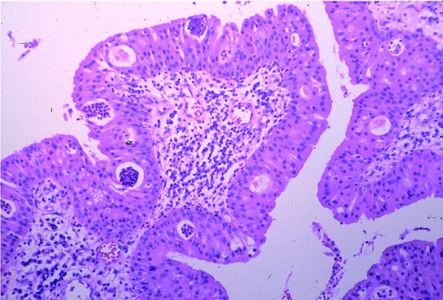 Adenoma Papilloma Nomenclature