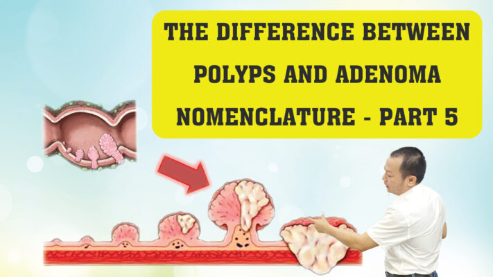 THE DIFFERENCE BETWEEN POLYPS AND ADENOMA NOMENCLATURE PART 5 01