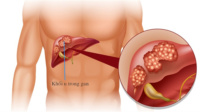 khoi u ac tinh 1